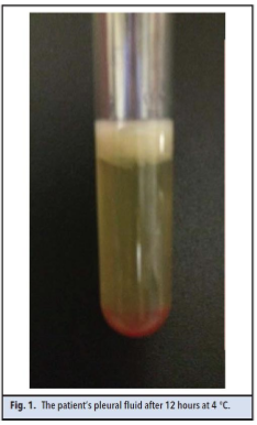 Fig 1. The patient's pleural fluid after 12 hours at 4 degrees C