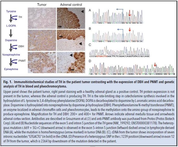 Fig 1. Immunohistochemical studies of TH in the patient tumor contrasting iwth the expression of DBH and PNMT and genetic analysis of TH in blood and pheochromocytoma