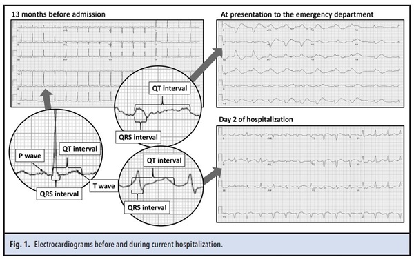 Figure 1electrocardiograms before and during current hospitalizations